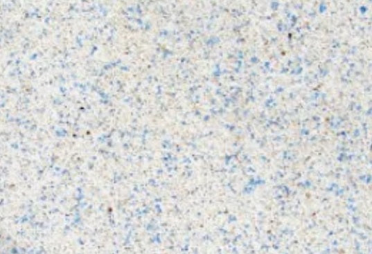 Rough, over-exposed pool plaster after aggressive acid washing — a common surface issue corrected with Pool Plaster Discs.